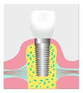 dental implant Newport Beach